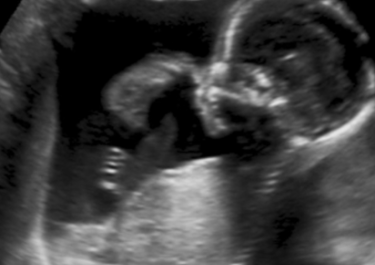 cliqué échographique d'un foetus